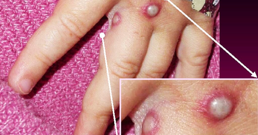 Monkeypox rash 